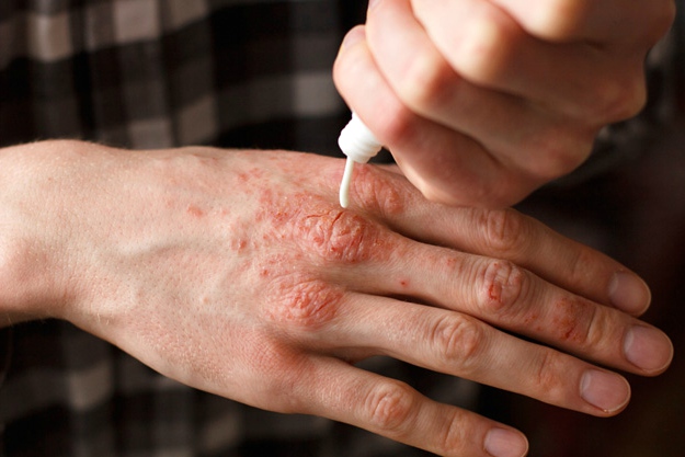 Treatment of Psoriasis | What Causes Psoriasis? Symptoms and Treatment | triggers for psoriasis
