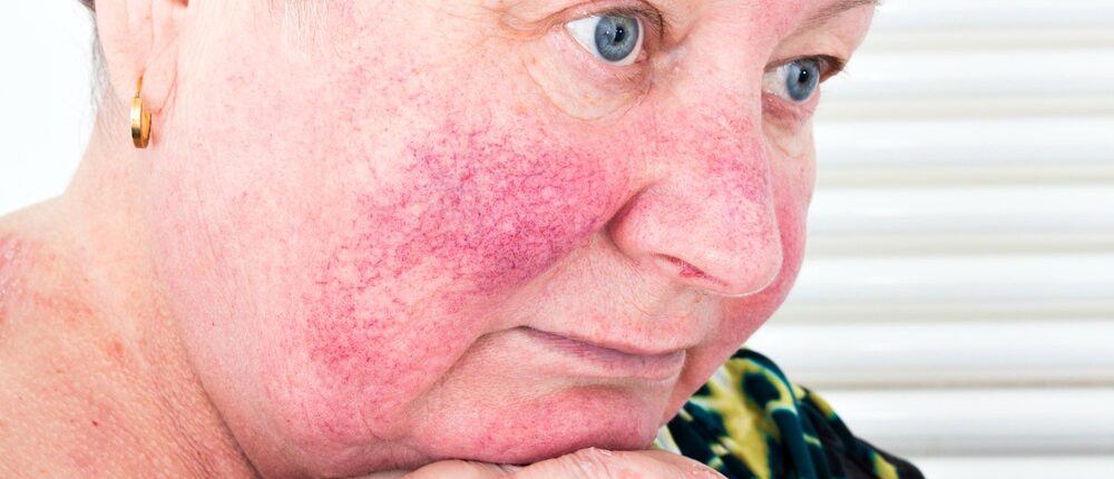 FEATURE | Causes of Rosacea: Know What to Avoid | rosacea causes