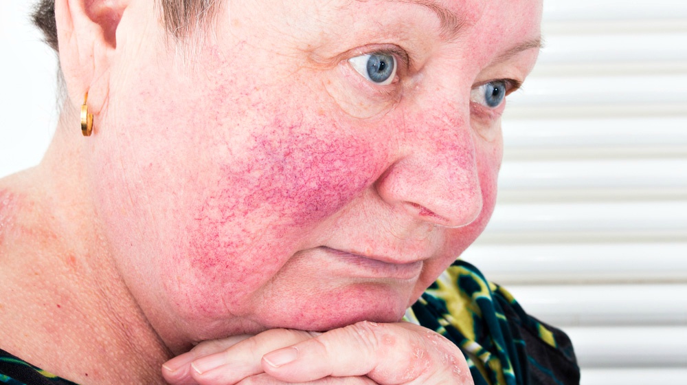 FEATURE | Causes of Rosacea: Know What to Avoid | rosacea causes