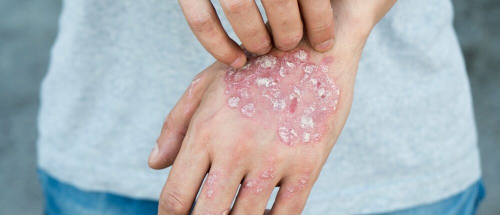 Feature | What Causes Psoriasis | What Causes Psoriasis? Symptoms and Treatment | how to treat psoriasis