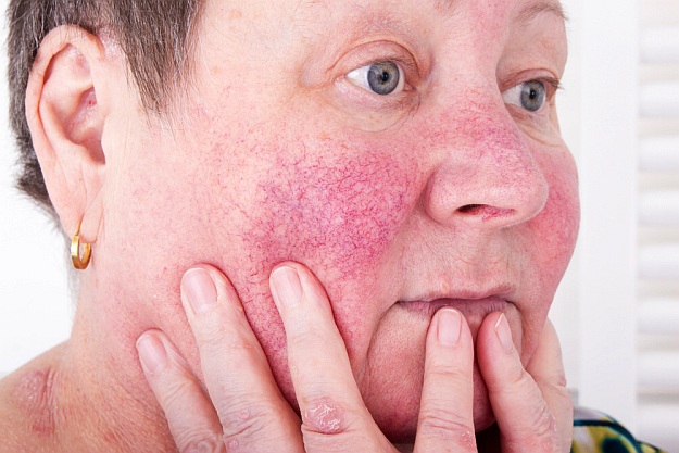 Types of Rosacea | Rosacea Natural Treatment | How to Get Rid of Rosacea Naturally | blood vessels 