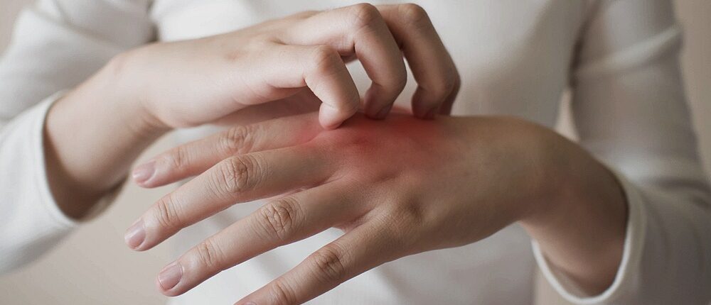 Feature | Got Hand Eczema? Try These Natural Eczema Treatments For Dry Skin | blood vessels