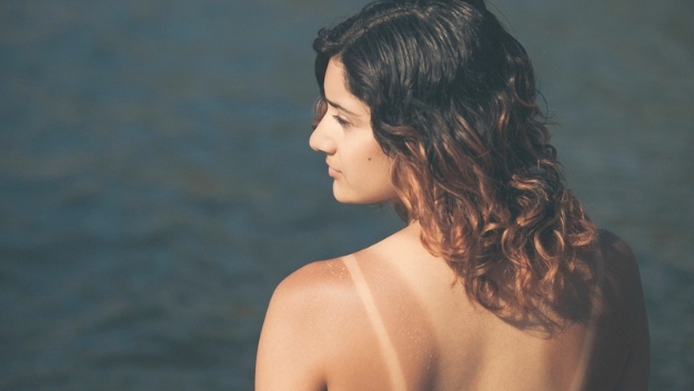 Sunburn | Natural Remedies for Skin Rash | skin rash remedies