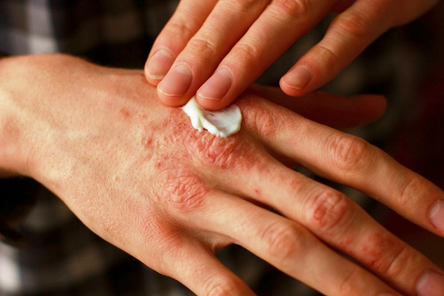 How to Treat Psoriasis | What Is Psoriasis? Psoriasis Symptoms and Treatment