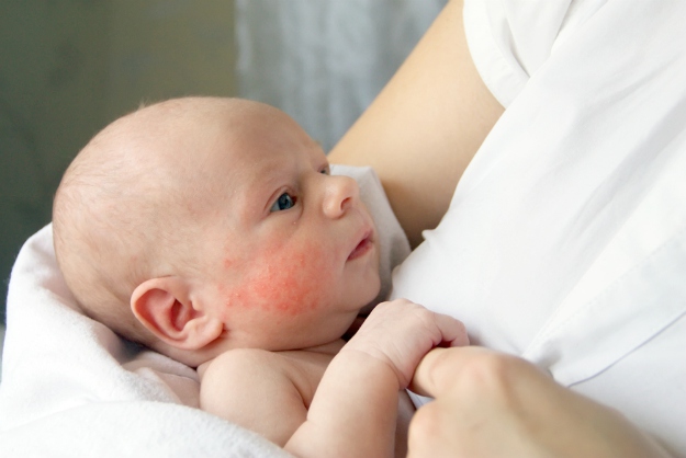 Common Eczema Symptoms | Toddler Eczema Care and Treatment | atopic dermatitis
