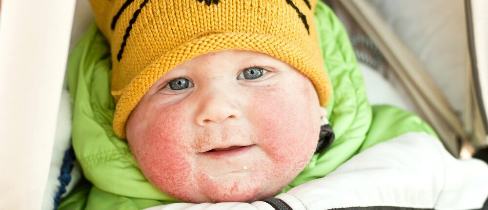 FEATURE | How To Treat Baby Eczema On Face | allergic reaction