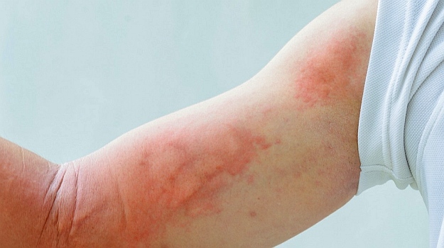 Hives | Natural Remedies for Skin Rash | skin rash causes