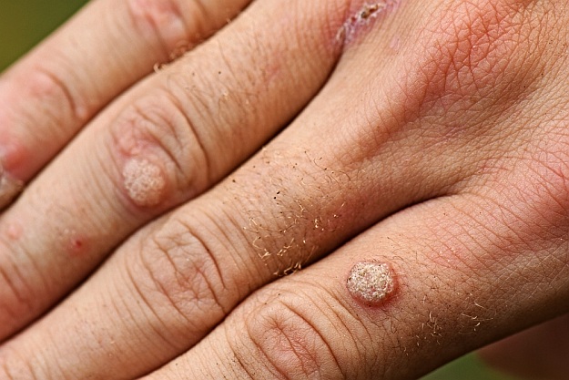 Warts | Natural Remedies for Skin Rash | skin rash remedies