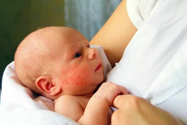 What Causes Eczema in Infants and Toddlers? | What Causes Eczema? | foods that cause eczema outbreaks