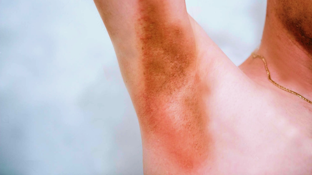 Feature | How To Treat Inverse Psoriasis Naturally | inverse psoriasis treatment