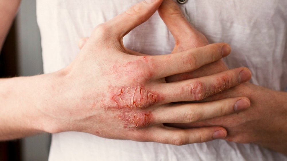 Feature | What Causes Eczema? | what causes eczema in adults