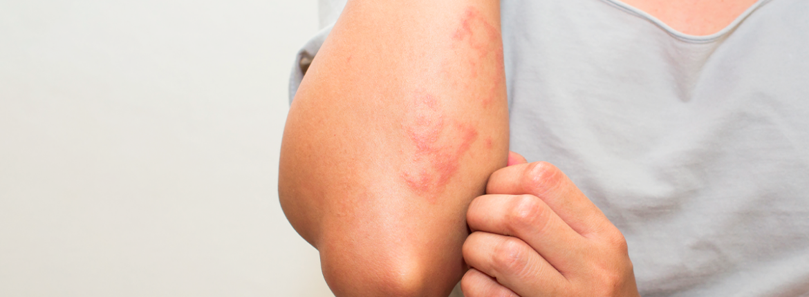 eczema immune disease