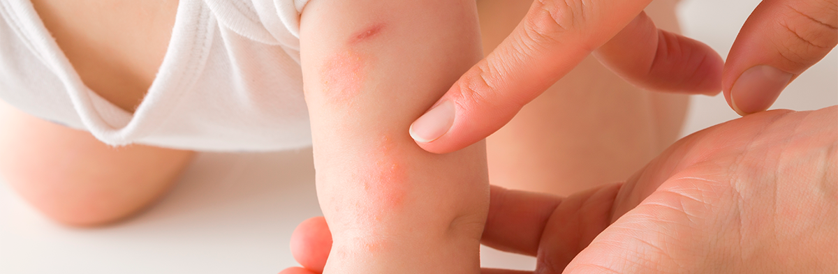 eczema immune disease